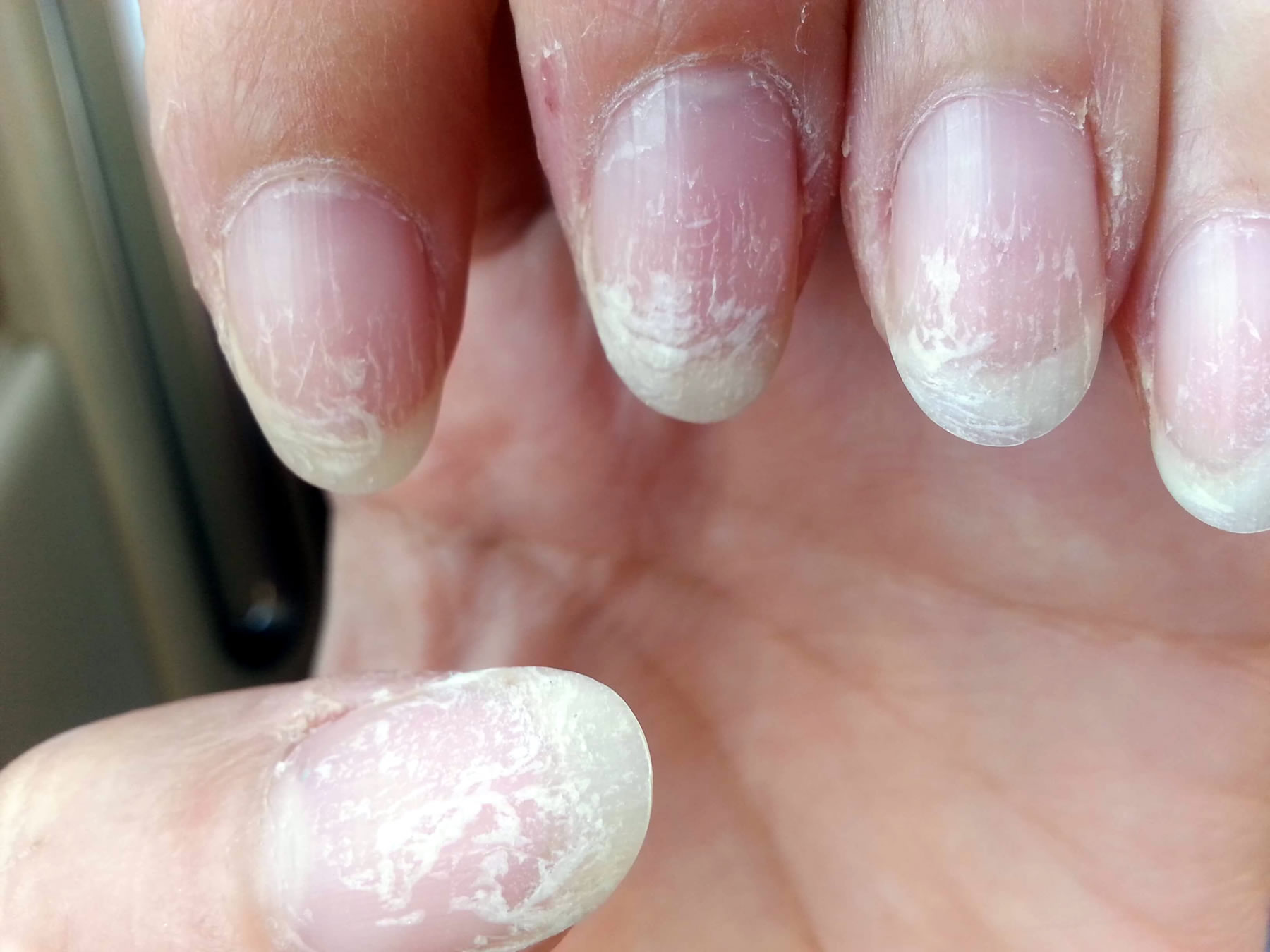 Проблемы с ногтями после гель лаков фото