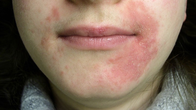 Атопическая кожа Причины атопического дерматита